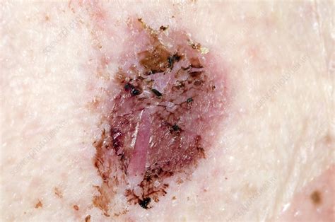 Healed Pemphigoid Blister Stock Image C0169235 Science Photo Library
