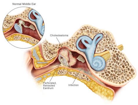 Cholesteatoma Symptoms Treatment And More Happy Ears