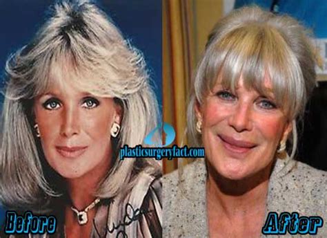 Linda Evans Facelift Before And After Plastic Surgery Facts