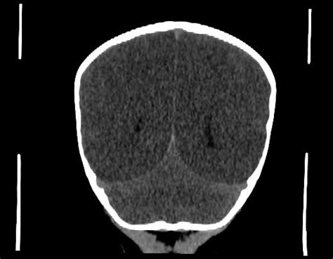 Anoxic Brain Injury Image
