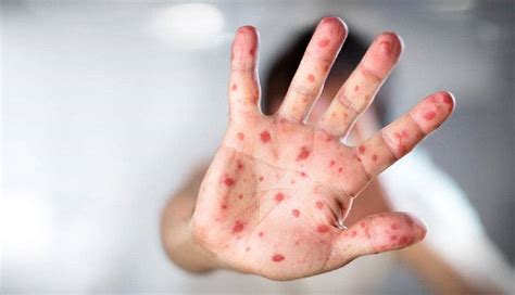 German Measles Symptoms Causes And Treatments New Life Ticket