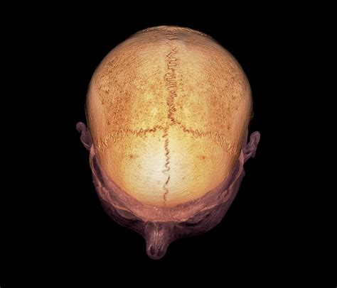 Skull Sutures Photograph By Zephyrscience Photo Library