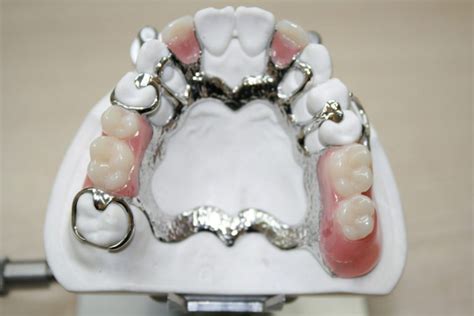 Removable Partial Dentures Flexible Partials Removable Partial