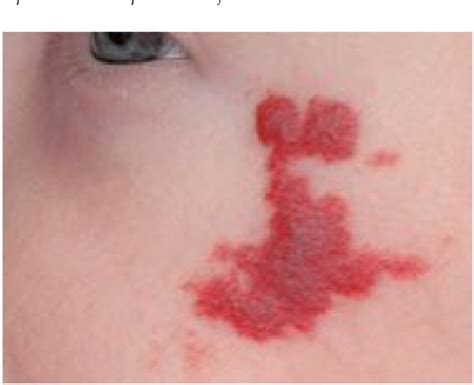 Figure 1 From Childhood Skin Rashes Semantic Scholar