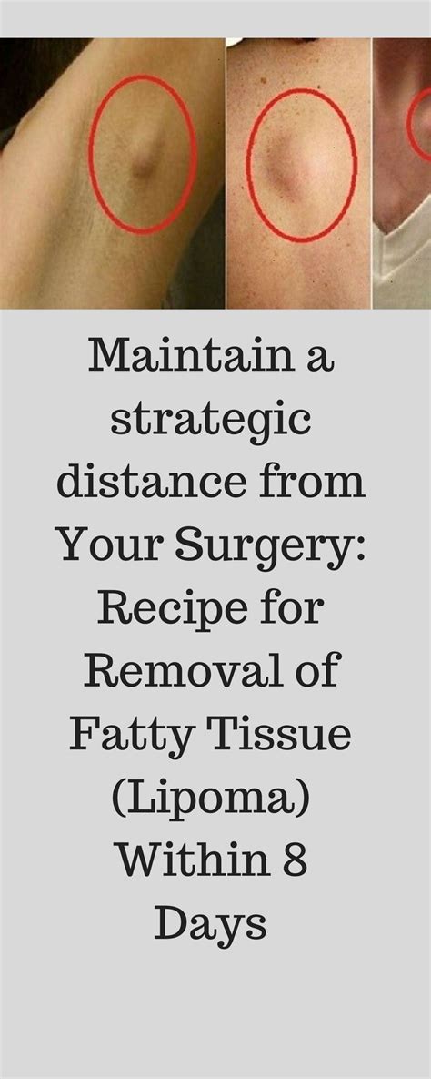 Maintain A Strategic Distance From Your Surgery Recipe For Removal Of