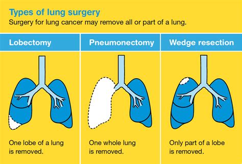 Types Of Cancer Surgery Vrogue Co