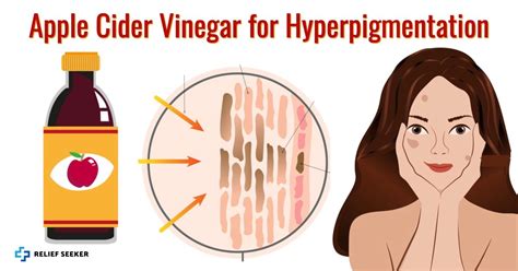 Apple Cider Vinegar For Hyperpigmentation