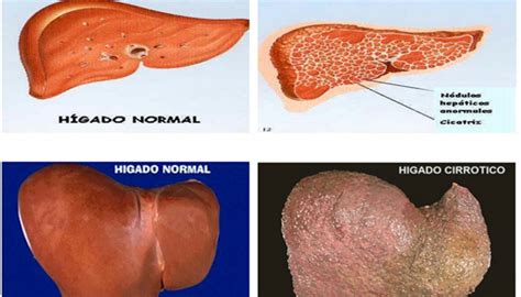 Problemas de cirrosis hepática Multicanal Catamayo