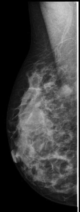C Mammography Is Performed After Pathological Findings Are Seen In An