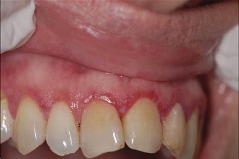 Desquamative Gingivitis In Dermatological Disorders Indian Journal Of