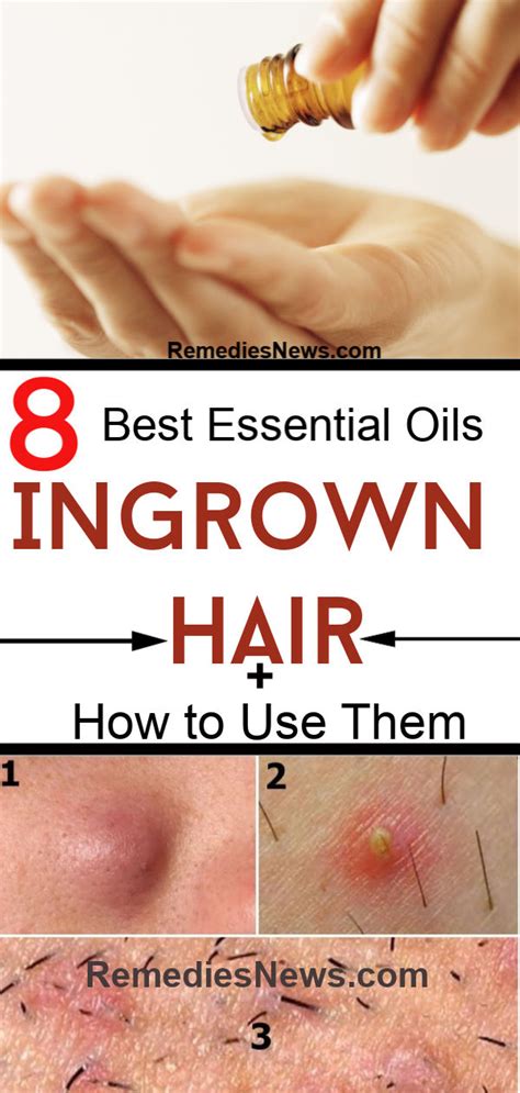 How To Use Essential Oils For Ingrown Hair 8 Best Home Remedies