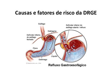 doença do refluxo gastroesofágico