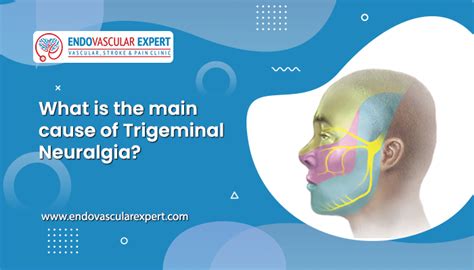 What Is The Main Cause Of Trigeminal Neuralgia Signs And Symptoms