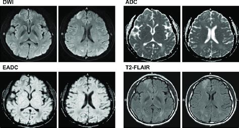 Persistent High Signal Intensity Lesions On Diffusion Weighted Imaging