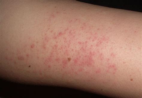 Little Pimples On Arms Pictures Photos