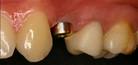 Implants Avec Pilier De Cicatrisation Et Dent Provisoire Sur Dent Naturelle Cabinet Dentaire