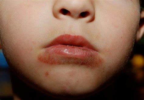 Baby Acne Or Rash Around Mouth