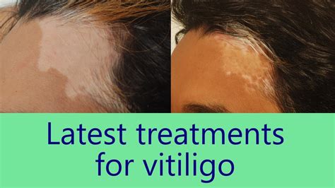 Cure White Patches On Skin Advance Treatment For Vitiligo Dr Rinky