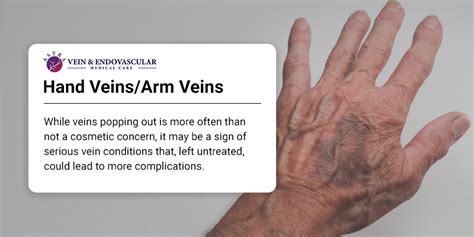 visible hand veins and why you have them vein and endovascular medical care