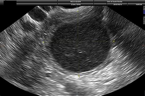 Fetal Ovarian Cyst Ultrasound