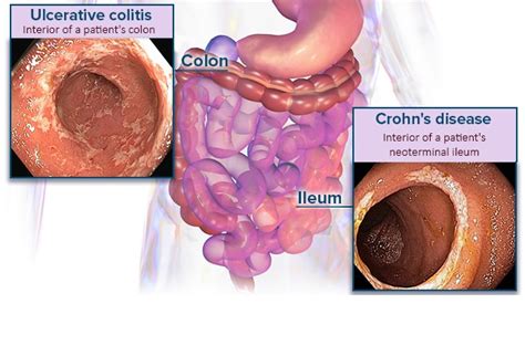 Inflammatory Bowel Disease Cases To Test Your Dx Rx Skills