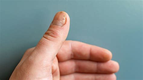 How To Live Better With Nail Psoriasis