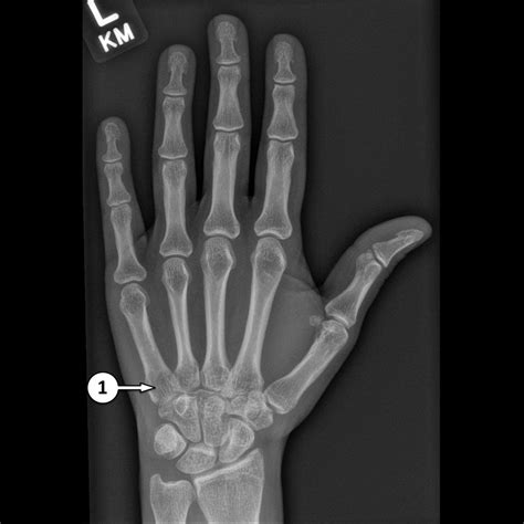 Normal Hand X Ray Captions Fortify