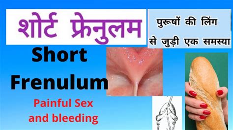 Tight Frenulum Pain In Sex Short Frenulum Dr Prof Santosh Kumar Pgi