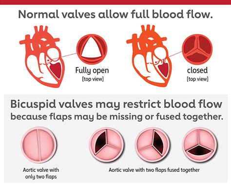 Problem Heart Valve Stenosis American Heart Association