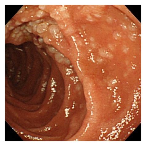 Typical Endoscopic Image Of Follicular Lymphoma Of The Duodenum My