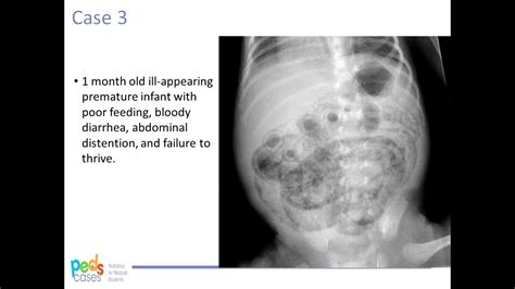 Approach To Pediatric Abdominal X Rays Youtube