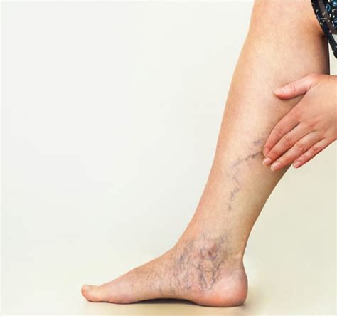 Top 4 Facts You Should Know About Varicose Veins Nj Spine And Ortho