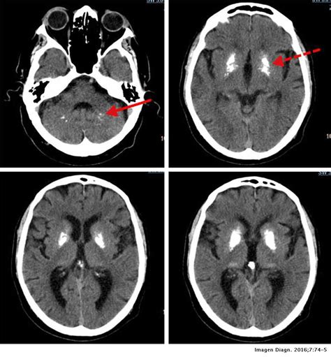 Primary familial brain calcification (pfbc), also known as familial idiopathic basal ganglia calcification (fibgc) and fahr's disease, is a rare, genetically dominant, inherited neurological disorder characterized by abnormal deposits of calcium in areas of the brain that control movement. Enfermedad de Fahr | Imagen Diagnóstica