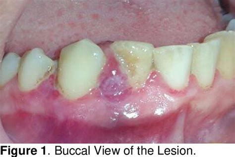 Figure 2 From Nonsurgical Management Of Rapidly Recurrent Gingival