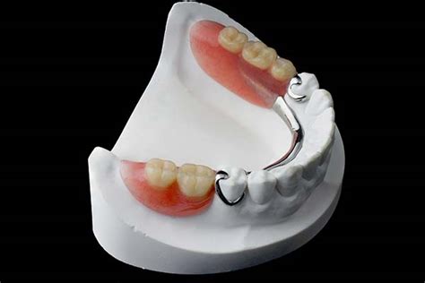 Partial Dentures North Street Dental
