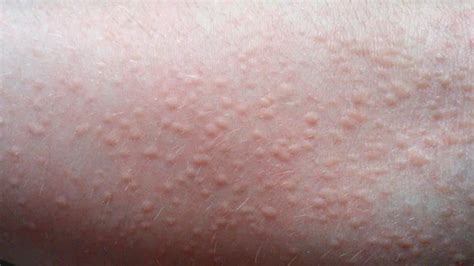 Itching Pruritis Pictures Causes Remedies And More