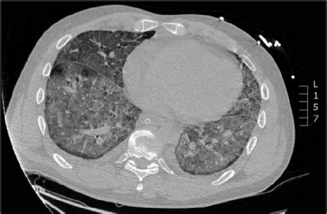 Case 1 High Resolution Computed Tomography Scan Showing Diffuse