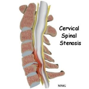 Cervical Stenosis Condition Antonio Webb MD