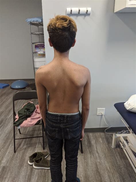 Back Pain: Scoliosis | Motion Science Physiotherapy Clinic