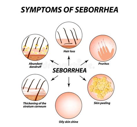 Symptoms Of Seborrhea Seborrhea Skin And Hair Dandruff Seborrheic