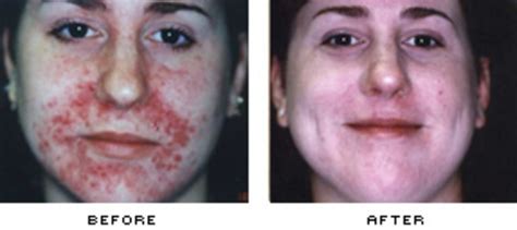 Ipl Photofacial Treatment Intense Pulsed Light Facial