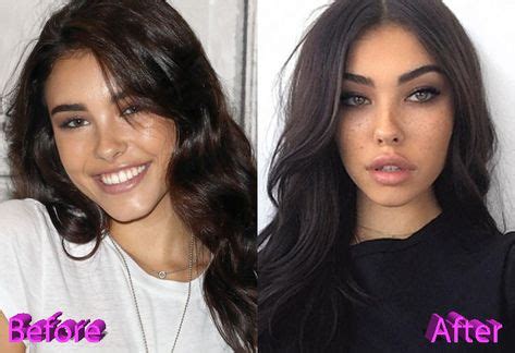 Soon after undergoing madison beer's pictures before and also after she got fame, we think she's not precisely the type who requires a lot of cosmetic surgeries. Madison Beer Before and After Cosmetic Surgery | Laser ...