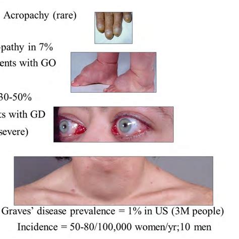 Pdf Graves Disease Syndrome A Need For Unified Therapy