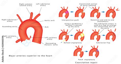 Coarctation Repair Coarctation Of Aorta Congenital Defect Of The