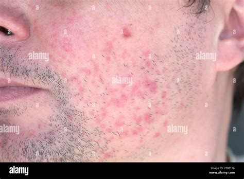 Dermatitis On Man Face Eczema Close Up Stock Photo Alamy