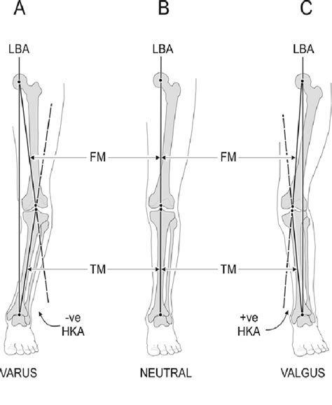 1 Common Patterns Of Frontal Plane Lower Limb Alignment Modified From