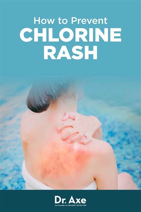 Chlorine Rash Symptoms Causes Treatment And Prevention Safe Home Diy