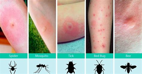 The Health Website Insect Bites And Stings