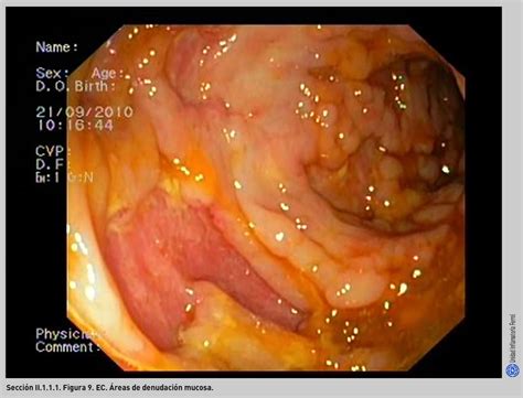 Other complications outside the gastrointestinal tract may include anemia, skin rashes, arthritis, inflammation of the eye, and fatigue. Endoscopia en la enfermedad de Crohn