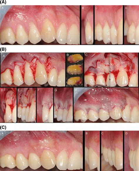 A Multiple Gingival Recessions From The Canine To The Molar In The